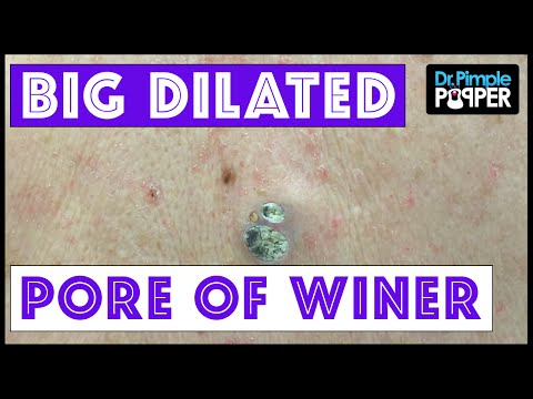 Video: Dilated Pore Of Winer: Beeld, Oorzaken, Behandeling En Preventie