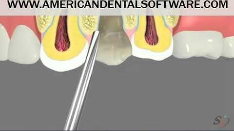 Dental Patient Education - Tooth Extraction 3D video
