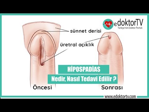 HİPOSPADİAS (Hipospadias nedir?  Nasıl Tedavi Edilir, Hipospadias Ameliyatı)