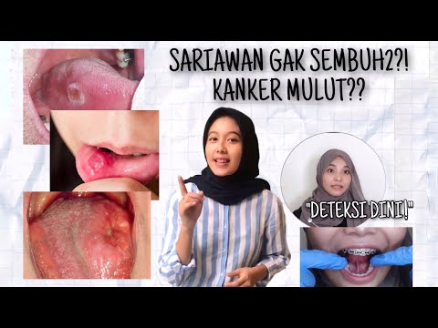 SARIAWAN TAK KUNJUNG SEMBUH?! WASPADA KANKER MULUT!