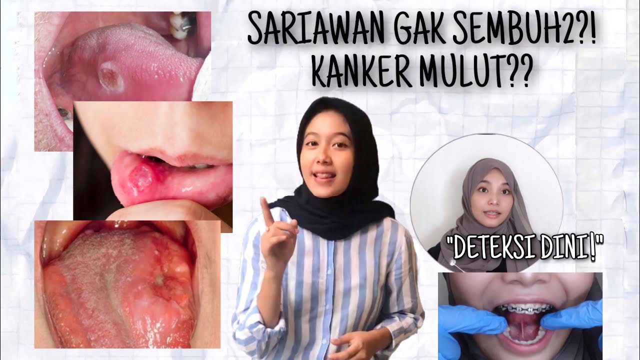 SARIAWAN TAK KUNJUNG SEMBUH?! WASPADA KANKER MULUT! 