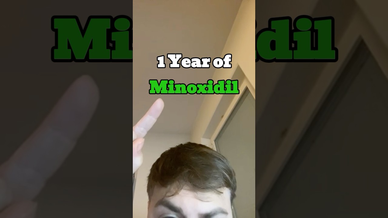This Is What 1 Year of Minoxidil Looks Like Month for Month