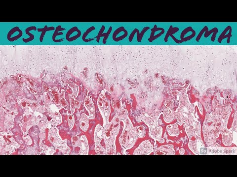 Osteochondroma (Exostosis): Bone Pathology Basics