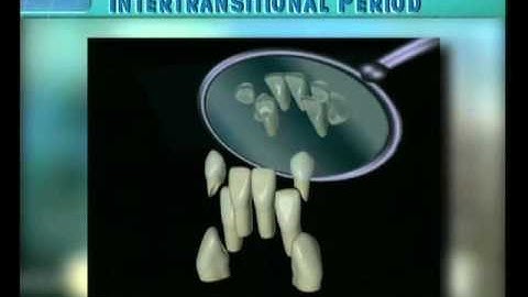 Clip 12: Transition of Mandibular Incisors with Shortage of Space