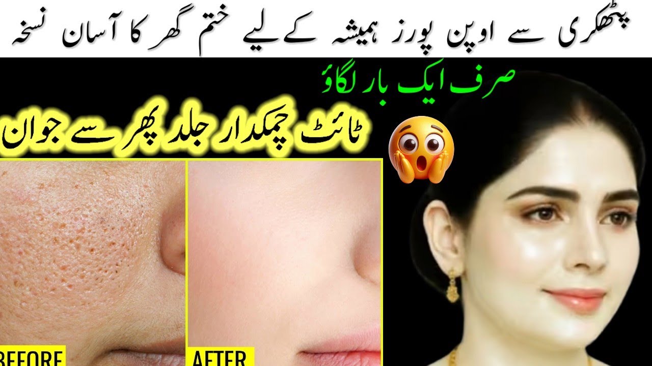 Say Goodbye To Open Pores Naturally At Home | Open Pores Hamesha K Liye Khatam 😱 100% Result 