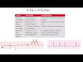 EKG Video 3 2