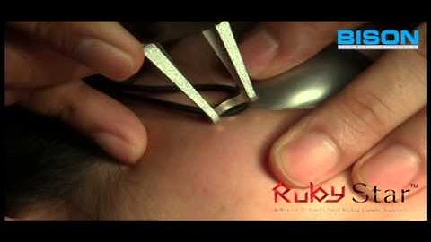 RUBY Laser(RubyStar)_694nm QSwitched_Clinical Video_BISON MEDICAL