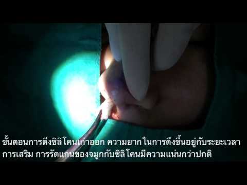 เคสแก้จมูก rhinoplasty by dr.boyz YB Clinic.