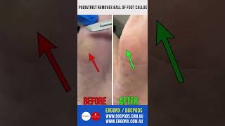 Painful Ball Of Foot Callus Removal