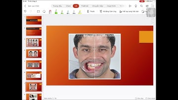 Quy trình Digital Smile Design: Ảnh và Video