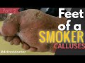 Feet of a Smoker:  Severe Effects of Smoking, Trimming Calluses and Wound Care (Part 2)