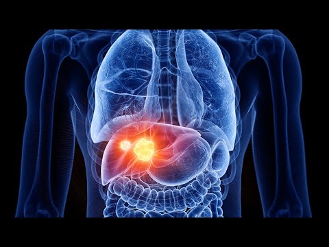 ღვიძლის გაცხიმოვნება! ეს უნდა იცოდეთ...