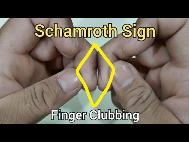 Figure: Measuring finger clubbing - MSD Manual Professional Edition