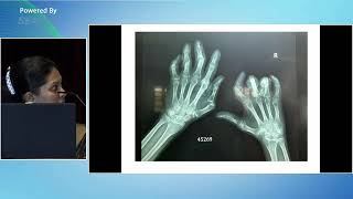 Digital Gangrene as the First Manifestation of Systemic Vasculitis - Dr Angela Wijeyeratna,