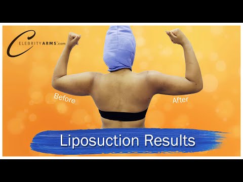 Lipo 360° Arms | Celebrity Arms™ Liposuction | Immediate Results | Expert Dr. Thomas Su