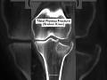 Broken Knee Treated with Robotic Knee Replacement | Tibial Plateau Fracture
