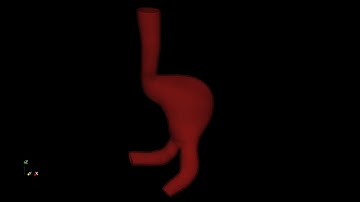 FSI aneurysm simulation in OpenFOAM