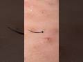 なんだかかわいい毛♡#hairremoval #blackheads #tweezers #ingrownhair #plucking #毛抜き