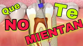 Que es una ENDODONCIA y cual es el PROCESO CORRECTO (caries profunda)