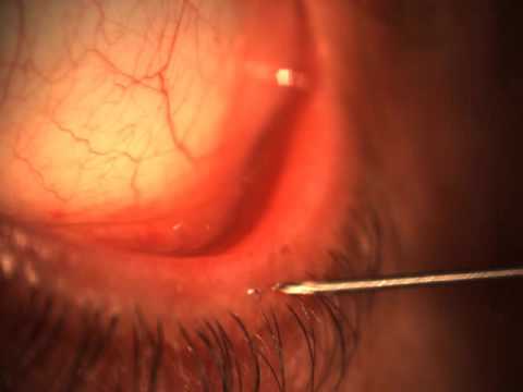 Video Removal Of Double Ingrown Eyelash Wait Till The End Youtube