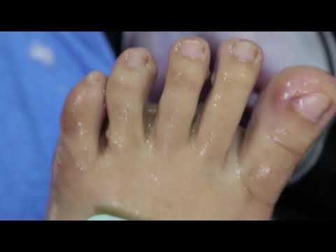 Ep_455 Foot skin removal 👣 น้องเขาปวดนิ้วเท้านึกว่าเล็บขบ พี่เอื้อมตรวจดูเกิดจากอะไร?