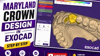 Maryland Crown Design in Exocad | Step by Step Dental CAD Design | Exocad Tutorial