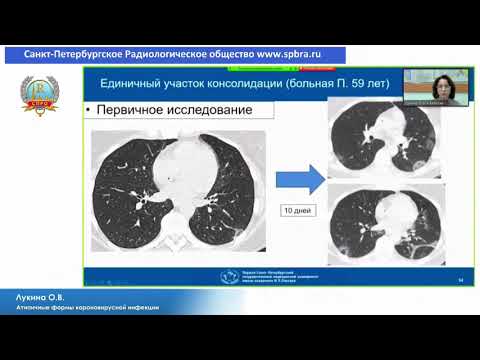 Лукина О.В. «Атипичные формы короновирусной инфекции»