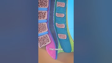 How A Spinal Tap Works 😨