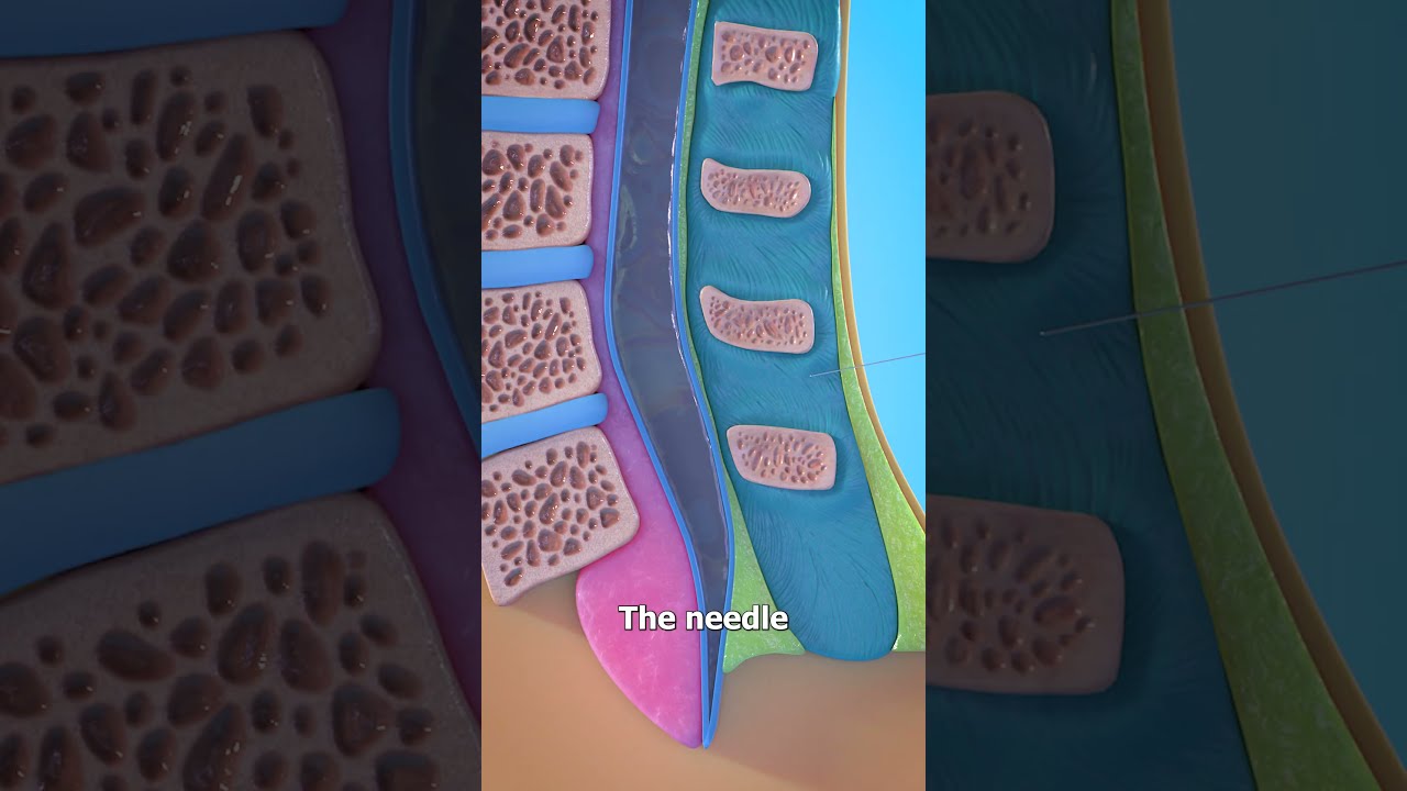 How A Spinal Tap Works 