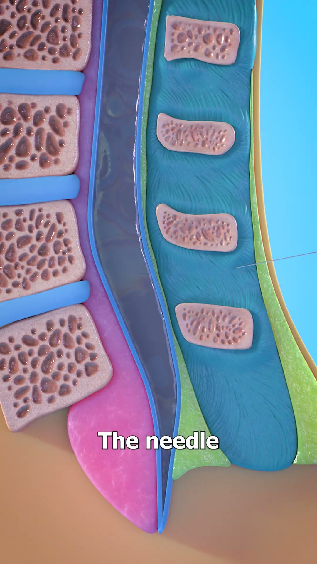 How A Spinal Tap Works ?