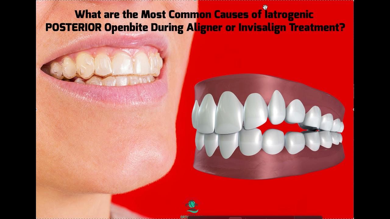 What are the Most Common Causes of Posterior Openbite DURING Invisalign