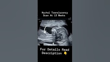 NT scan At 13 Weeks of Pregnancy| Nuchal Translucency Scan