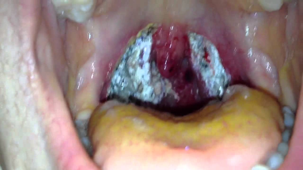 Tonsils In Adult 23