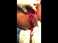 EPISIORRAFIA || Dr Garcia