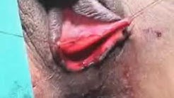 Anal Fistula_1