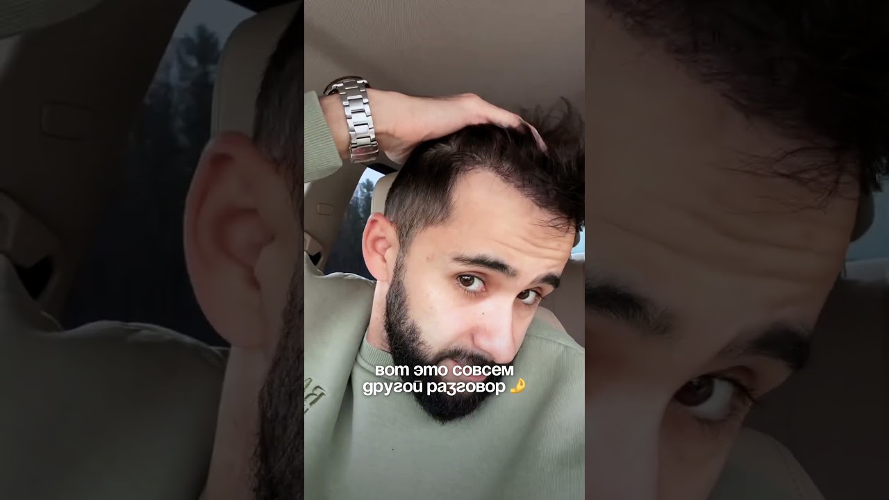 Сделал пересадку волос РЕЗУЛЬТАТ 