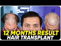 Hair transplant results  best cost  best hair transplant result