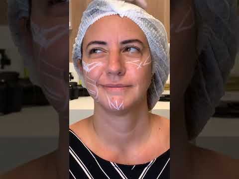 Preenchimento Facial na Prática - Parte 2