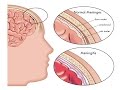 Meningitis