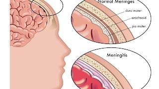 Meningitis