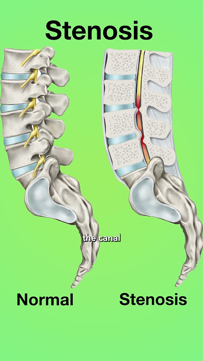 What Is Spinal Stenosis?  #surgeon