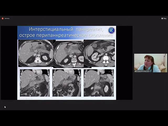Кудрявцева А.В. "Компьютерная томография острого и хронического панкреатита"