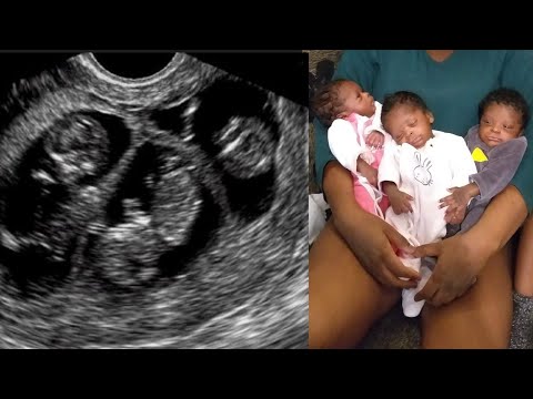 Vidéo: Est-il Possible D'identifier Des Jumeaux Sans échographie