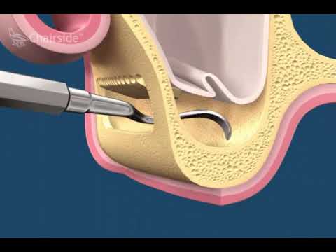 синус лифтинг с одновременной имплантацией