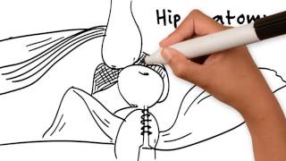 Hip Replacement By Dr Andrew Yun