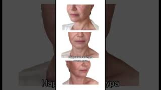 Когда лифтинга лица недостаточно #пластическаяоперация #лифтинг #хирургия #пластическийхирург