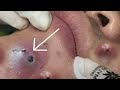 Big cystic acne blackheads extraction blackheads  milia whiteheads removal pimple popping 012