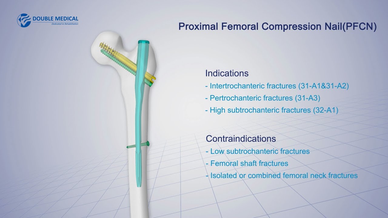 PFNA - Depuy Synthes - PDF Catalogs | Technical Documentation