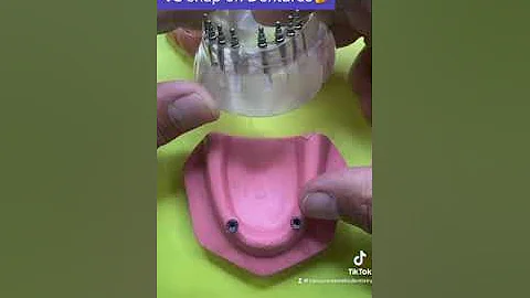 Snap in Dentures vs Snapon Dentures