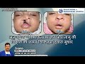 अत्यधिक चौड़े एकतरफा कटे होंठ और तालु दोष का शल्य सुधार